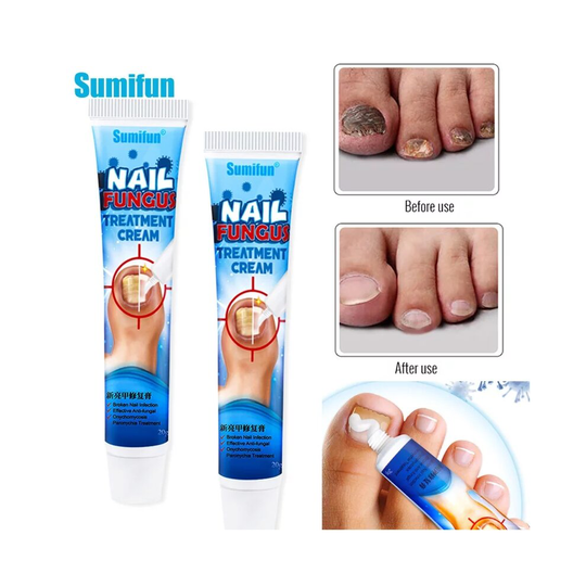 Chinese Herbal Toe Nail Fungus Treatment Cream Onychomycosis Paronychia Antibacterial Anti Fungal Infection Repair Ointment